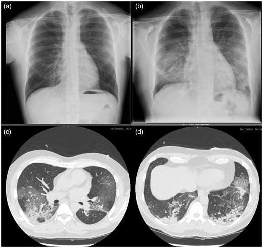 Chest X-ray showing bilateral opacification (b) that was not evident on a previous X-ray of the same patient 6 years before (a). (c) and (d) Chest computed tomography scan demonstrating typical radiological signs of crazy paving and ground glass opacities consistent with interstitial pneumonia severe acute respiratory syndrome coronavirus 2 (SARS-CoV-2) related.