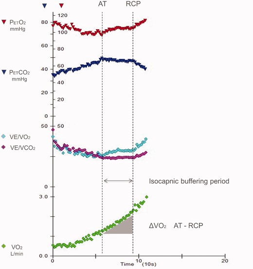 Ventilation, oxygen consumption (VO2) and minute ventilation (VE)/carbon dioxide production (VCO2) and derived parameter changes during exercise. The isocapnic buffering period is identified between the anaerobic threshold (AT) and the respiratory compensation point (RCP). Reproduced from Carriere et al.17 with permission.