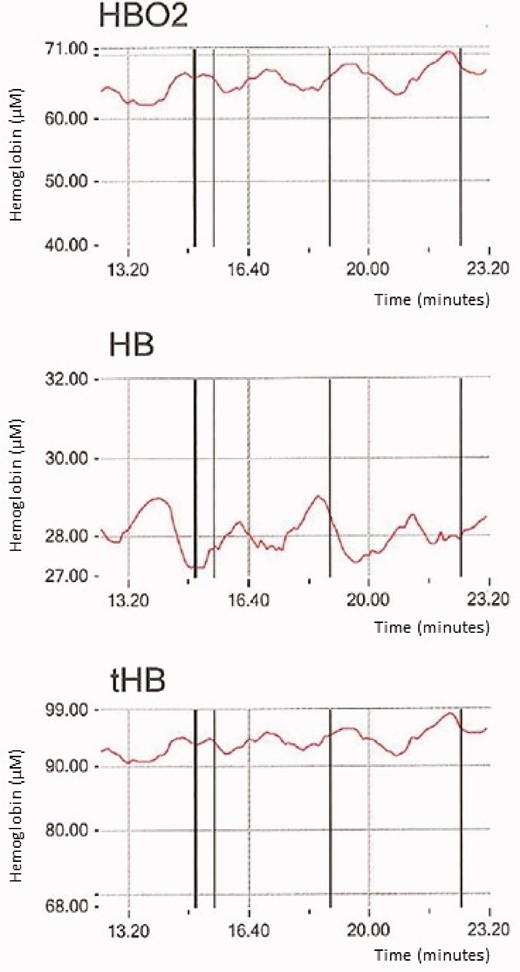 Measurements of near infrared spectroscopy (NIRS) data at rest in a patient with periodic breathing at rest. Fluctuation of oxygenated haemoglobin (HBO2), de-oxygenated haemoglobin (HB) and total haemoglobin (tHB) are reported. The cycle length is approximately 130 seconds.