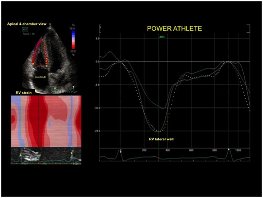 Right ventricular strain curve in a control subject with normal right ventricular deformation of lateral wall.