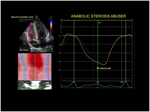 Right ventricular strain curve in a power athlete abusing anabolic-androgenic steroids. Right ventricular deformation of lateral wall was significantly impaired.