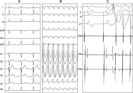 Surface ECG at rest and during tachycardia: ( A ) baseline ECG; ( B ) clinical wide complex tachycardia; ( C ) initiation of tachycardia by ventricular premature beat. HRA, high right atrium; CSd, distal coronary sinus; CSp, proximal coronary sinus.