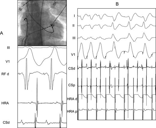 Termination. ( A ) Site of ablation on left lateral mitral annulus where accessory pathway potential is recorded. ( B ) Disapearance of pre-excitation during ablation while pacing the atrium. There is a change in QRS morphology and 2:1 conduction. HRA, high right atrium; HRA d, distal high right atrium; HRA p, proximal high right atrium; CSd, distal coronary sinus; CSp, proximal coronary sinus; RF d, ablation catheter distal.