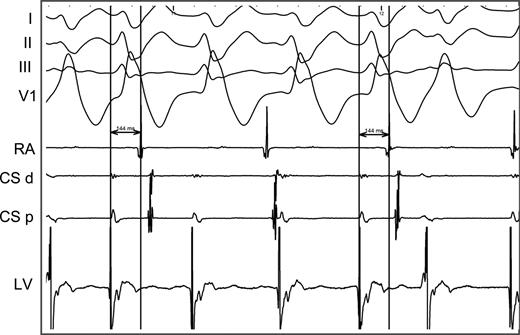 Non-sustained ventricular tachycardia mechanically induced by the map catheter into the left ventricle. Note that the intermittent concentric ventriculo-atrial conduction suggesting no additional retrograde pathway was present in this patient.