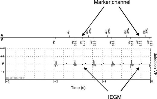 Self-limiting ventricular fibrillation inappropriate detection due to T-wave oversensing. The implantable cardioverter defibrillator was implanted in a 34-year-old male for secondary prevention. Twenty days after discharge a ventricular fibrillation detection occurred not followed by therapy delivery. Arrows indicate T-wave oversensing causing inappropriate detection. No further inappropriate detections occurred after reprogramming of ventricular sensitivity.