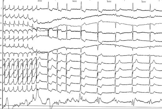 Atrioventricular re-entrant tachycardia followed by a short episode of sinus tachycardia and then a sinus bradycardia.