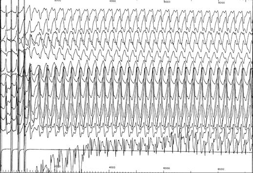 Induction of antidromic tachycardia with short RR intervals between pre-excited beats (200 ms).
