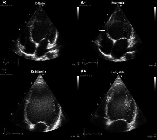Apical four-chamber view. End-diastolic ( A ) and end-systolic ( B ) frame in the apical four-chamber view prior to radiofrequency ablation of a parahisian pathway in a 10-year-old boy. Typical bulging of basal septum in end-systole ( B , white arrow) is seen along with significantly decreased left ventricular ejection fraction of 26%. End-diastolic ( C ) and end-systolic ( D ) frame in the apical four-chamber view 3 months after ablation. Paradoxical septal motion is abolished and ejection fraction has increased to 43%.