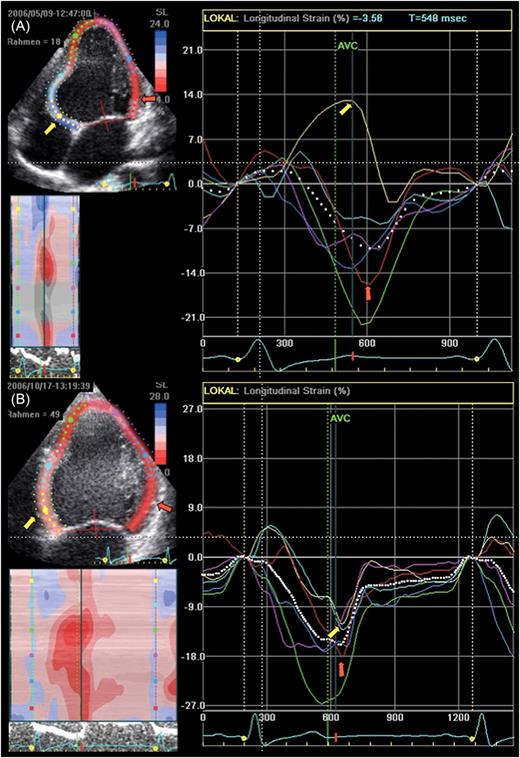 Longitudinal two-dimensional strain in the apical four-chamber view of the same patient as shown in Figure 2 is displayed. Colour coding of the strain curves refers to the respective left ventricular segments. The longitudinal two-dimensional strain in the apical four-chamber prior to radiofrequency ablation of the parahisian pathway ( A ): early activated basal septum (yellow arrow and curve) shows relaxation and stretch (positive strain) throughout most of the whole systole caused by contraction (negative strain) of normally timed left ventricular segments (i.e. basal lateral wall, red arrow). Early contraction of the unloaded pre-excited segment could not be detected in this analysis. Three months after ablation ( B ), there is an almost complete normalization of the segmental contraction timing with good alignment of septal (yellow arrow) and lateral wall (red arrow) peak negative strain.