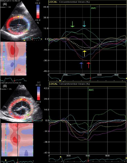 Circumferential two-dimensional strain in the parasternal short-axis view at the level of the mitral valve is displayed. Colour coding of the strain curves refers to the respective left ventricular segments. Prior to radiofrequency ablation of a right septal pathway ( A ), circumferential two-dimensional strain curves at the level of the mitral valve display an inhomogenous beginning of peak negative circumferential strain. Furthermore, in early systole, anterior and lateral segments display stretch while septal, anterioseptal, and inferior segments display contraction. One month after ablation ( B ), circumferential two-dimensional strain curves display an almost homogenous beginning of peak negative circumferential strain.