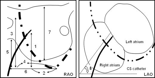 The measurements of the transseptal puncture site and adjacent structures. The lines with double arrows illustrate the various measurements obtained in the fluoroscopic view: 1, V N-CSO; 2, H N-CSO; 3, V RS-CSO; 4, H RS-CSO; 5, V RI-CSO; 6, H RI-CSO; 7, VLA; 8, N -angle. The abbreviations are as in the text.