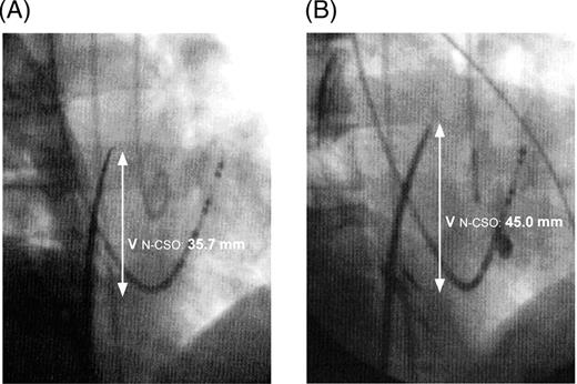 The successful puncture site in the first procedure ( A ) was lower than that in the second procedure ( B ) during the atrial end-diastolic phase.