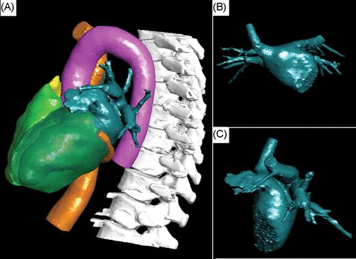 Visualization of the structures of interest automatically segmented by the software and manually optimized. ( A ) Left lateral view. Visualization of the left atrium (dark green), the inferior vena cava and coronary sinus (orange), the right and left ventricles (green), the right atrium (yellow), the aorta (pink), and the spine (white). ( B and C ) Antero-posterior and left lateral views of the segmented left atrium.