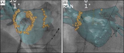 Tagging ablation points around the right and left pulmonary veins' ostia. ( A ) Quadripolar catheter inserted into the coronary sinus. Decapolar circumferential catheter inserted into the right inferior pulmonary vein and ablation catheter in the right superior vein. Internal view of the computed tomography volume (endoscopic view) showing the ostium of the right inferior pulmonary vein and the intervenous right ridge. ( B ) Decapolar circumferential catheter inserted into the right superior pulmonary vein and ablation catheter at the ostium of the right superior pulmonary vein.