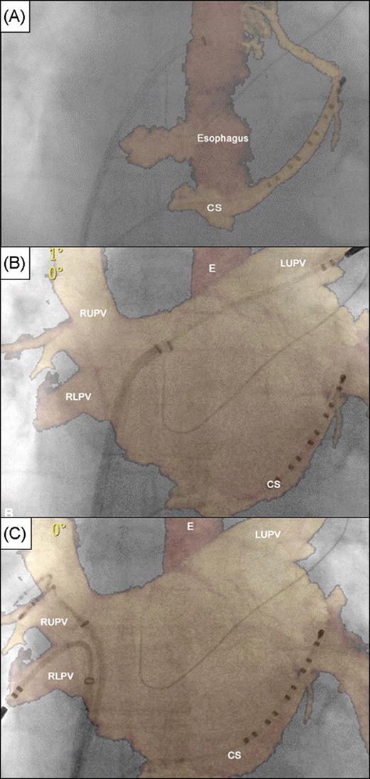 Registration based on coronary sinus and contralateral pulmonary veins using the commercial version. ( A – C ) Panels in antero-posterior fluoroscopic view showing segmentation of coronary sinus and oesophagus only with perfect registration of coronary sinus catheter ( A ) and subsequent adjustment based on introduction of catheters into left superior pulmonary vein ( B ) and right upper and lower pulmonary veins ( C ). E, oesophagus; CS, coronary sinus; LUPV, left superior pulmonary vein; RUPV, right upper pulmonary vein; and RLPV, right lower pulmonary vein.