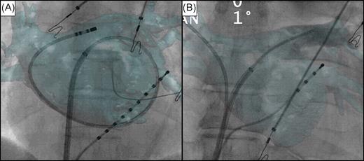 Validation of computed tomography registration. Antero-posterior fluoroscopic view with computed tomography overlay. Decapolar ( A ) and quadripolar ( B ) catheters inserted into the coronary sinus. ( A ) Registration based on catheter manipulation confirmed by looping a catheter in the left atrium accurately matching the overlaid computed tomography volume. ( B ) Ablation catheter placed into the right superior pulmonary vein. Contrast injection at the ostium of the left superior pulmonary vein shows a perfect alignment of both images.