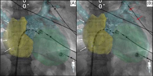Example of computed tomography registration based on heart contour (including reconstruction of both atria and the left ventricle). Antero-posterior fluoroscopic view with computed tomography overlay. Decapolar catheter inserted into the left atrium through a trans-septal sheath. The computed tomography volume overlay was first aligned by using the right lateral atrial contour ( A and B , white arrows) and then the rest of the heart contour was superimposed visually, with assistance of high resolution fluoroscopy ( B , red arrows).