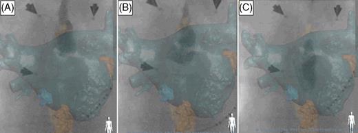 Example of oesophageal reconstruction and real-time oesophagus course outlined by barium swallow. Antero-posterior fluoroscopic view with computed tomography overlay of the left atrium and the oesophagus. Decapolar catheter inserted into the coronary sinus. Barium swallow showing a close match between the overlaid computed tomography image and the fluoroscopic image at different stages of contrast transit (from A to C ). Arrows on the images represent radio opaque markers used for alignment between Stereotaxis and CARTO systems.