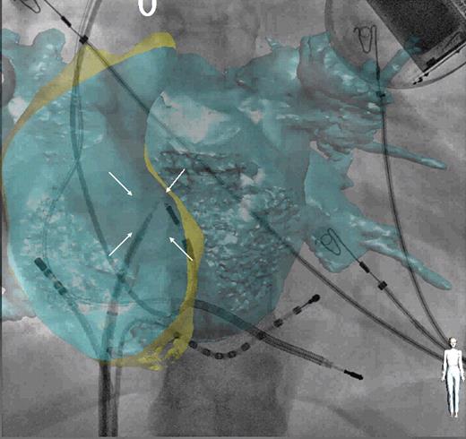 Example of trans-septal catheterization using computed tomography overlay. Antero-posterior fluoroscopic view with computed tomography overlay of both atria. Decapolar catheter positioned in the coronary sinus and ablation catheter in the right atrium. Trans-septal needle positioned onto the fossa ovalis (white arrows) before the puncture.