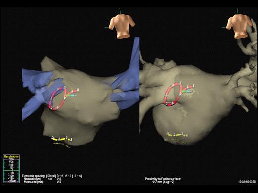 Integration of computed tomography with electro-anatomic mapping. In this example, a pre-procedural computed tomography scan of the left atrium is merged with a non-contact mapping system, NavX™. The positions of the circular mapping catheter, the coronary sinus catheter, and the ablation catheter can be seen (red, yellow, and green, respectively). The left-hand panel shows the images prior to merging, using fixed reference points and the right-hand panel shows the final result.