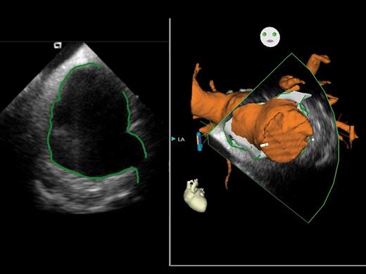 Using this new system (CARTO SOUND™), real-time images using intra-cardiac echocardiography can be integrated into the electro-anatomical mapping system, CARTO™. The left-hand panel shows the intra-cardiac echocardiography image of the left atrium, with manual delineation of the atrial walls and pulmonary venous ostia, whereas the right-hand panel demonstrates the three-dimensional representation of the left atrium and attached structures taken from the intra-cardiac echocardiography image.