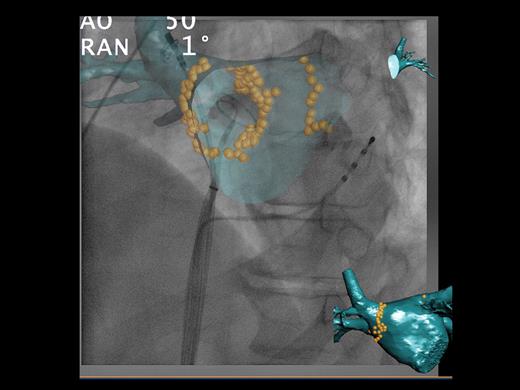 Phillips computed tomography overlay system™. Using the system, a pre-procedural computed tomography scan of the left atrium is overlaid onto live fluoroscopic images. In this example, an endoscopic view has been chosen to show the internal surface of the left atrium. The ablation points have been tagged with yellow orbs. The coronary sinus catheter can be seen, the circular mapping catheter has been placed in the right inferior pulmonary vein, and the ablation catheter is within the right superior pulmonary vein. In this system, the rotation of the computed tomography overlay is parallel to that of the C-arm, allowing accurate catheter positioning, in any view.