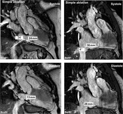 Two representative magnetic resonance images taken from a patient with a simple (left panel) and difficult (right panel) CTI ablation procedure. Images depict an approximate equivalent of an approximate 30° RAO projection adjusted to give a perspective view perpendicular to the isthmus length. Images taken during mechanical systole (upper panels) and diastole (lower panels) are shown.