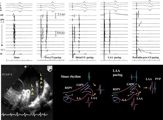 Upper series: electrogram tracings from the LSPV. From left to right ...