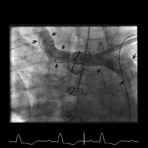 Venogram (anteroposterior projection) demonstrating the PLSVC and absent right-sided SVC (arrowed).