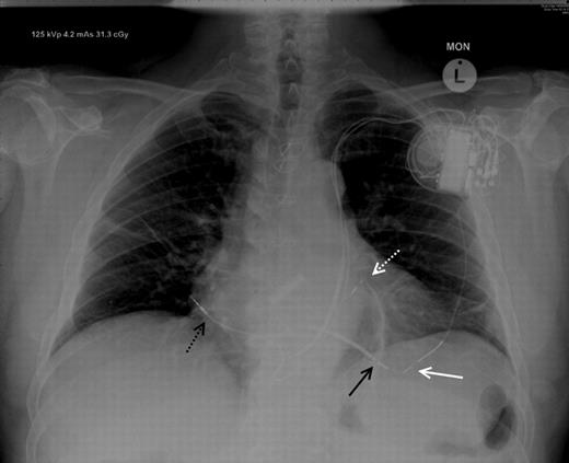 Chest X-ray (posteroanterior projection) demonstrating the final positions of the LV endocardial lead (white dotted line), right ventricular lead (black arrow), right atrial lead (black dotted arrow), and redundant epicardial LV lead (white arrow).