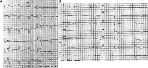 ( A ) An ECG showing DDD pacing with ventriculo-atrial retrograde conduction. The atrial spikes were not followed by atrial activity. ( B ) An ECG, after reprogramming, showing VVI pacing with hysteresis at 30 beats per minute. HR = 33 bpm; QT = 0.72″, QTcF = 0.59″, T waves inversion in V3 to V6 and in II, III, aVF.