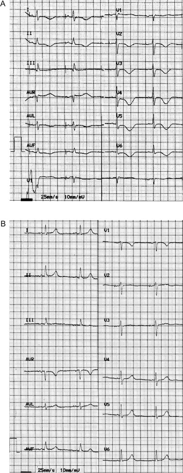 ( A ) An ECG, after repositioning of the atrial lead, showing restoration of normal AAI pacing (60 bpm), QT = 0.52″, QTcF = 0.52″. T wave inversion in I and AVL (positive in the previous ECG) and T wave flattening in III (negative in the previous ECG) are seen. ( B ) At 1-month follow-up, an ECG showing AAI pacing (60 bpm), QT = 0.44″, QTcF = 0.44″ and normal T waves.