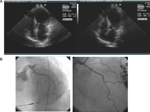 ( A ) Echocardiographic 2D images from the four-chamber view showing apical, mid-septal and mid-anterior ventricular dyskinesia and basal hyperkinesia ( B ) Coronary angiography performed on third hospital day demonstrating no significant epicardial stenosis (LAO caudal and RAO cranial projection).