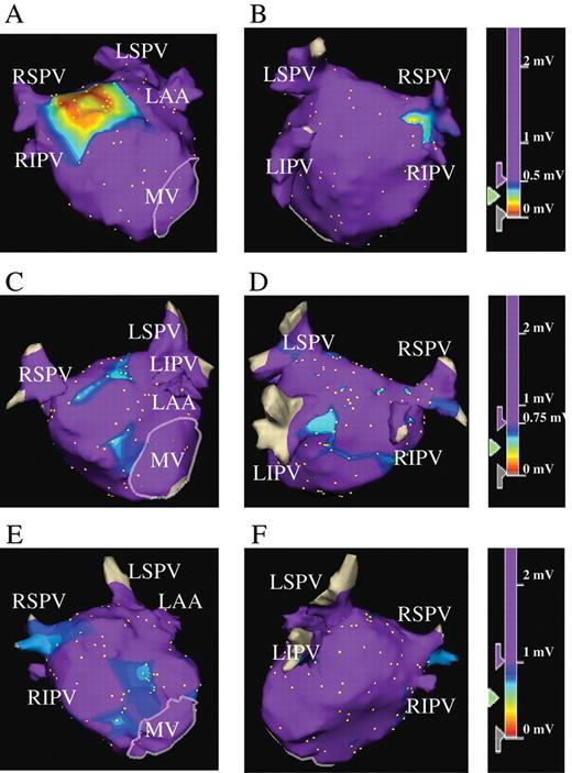 Representative three-dimensional voltage maps of the LA during SR. Patients in Group A ( A and B ), Group B ( C and D ), and Group C ( E and F ) from the anteroposterior (A, C, and E) and posteroanterior views (B, D, and F), respectively. (A and B) LVZ is defined as <0.5 mV for patients in Group A, including the case shown. Panels A and B show LVZ at the high septal wall, high anterior wall, and a part of the posterior wall LA. In the colour-coded key, purple represents areas with the voltages of >0.5 mV. (C and D) LVZ is defined as 0.5–0.75 mV (purple represents areas with voltages of >0.75 mV) for patients in Group B. Panels C and D show LVZ defined as 0.5–0.75 mV at the septal wall, anterior wall, and posterior wall of LA. Note that patients in Group B, including the case shown, did not have LVZ defined as <0.5 mV. (E and F) LVZ is defined as 0.75–1.0 mV (purple represents areas with voltages of >1.0 mV). Panels E and F show LVZ defined as 0.75–1.0 mV at the septal wall, anterior wall, and a part of the posterior wall of LA. Note that patients in Group C, including this patient, did not have LVZ defined as <0.75 mV. LA, left atrium; SR, sinus rhythm; LVZ, low-voltage zone; RSPV, right superior pulmonary vein; RIPV, right inferior pulmonary vein; LSPV, left superior pulmonary vein; LIPV, left inferior pulmonary vein; LAA, left atrial appendage; MV, mitral valve.