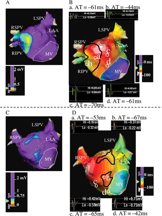 ( A and B ) Example of voltage (A) and activation maps (B) in the LA during SR for a patient from Group A. Activation map was created at 4 ms intervals. Both maps were obtained from the anteroposterior view. Panel A shows LVZ at the LA septal wall. The area surrounded by the black line in Panel B corresponds to the LVZ defined as <0.5 mV in Panel A. Examples of electrograms are also shown in Panel B. Starting from the LA anteroseptal wall, activation spreads out towards the entire LA. Note that isochronal lines become more crowded in the LVZ, which implies slowing of conduction through the LVZ defined as <0.5 mV. In contrast, isochronal lines in the non-LVZ are widely spaced, suggesting a normal CV. The electrograms at sites a and b are located in the LVZ, whereas those at sites c and d are in the non-LVZ. The local AT referenced to the coronary sinus at each point are –61 ms at site a and –44 ms at site b. The distance between the two points (a and b) is 16 mm, and the difference of local AT is 17 ms; thus, CV is 0.9 m/s. The local AT is –70 ms at site c and –61 ms at site d. The distance between the two points (c and d) is 17 mm, and the difference of local AT is 9 ms; thus, CV is 1.9 m/s. Fractionated electrograms were recorded during SR at sites a and b in the LVZ, and the electrogram morphology at sites c and d in the non-LVZ appears normal. ( C and D ) Examples of voltage (C) and activation maps (D) in the LA during SR of a patient in Group B. Activation map was created at 6 ms intervals. The area surrounded by the black line in Panel D corresponds to the LVZ defined as 0.5–0.75 mV in Panel C. Examples of electrograms are also shown in Panel D. Starting from the LA posteroseptal wall, the activation spreads out towards the entire LA. Isochronal lines in the LVZ are not crowded, even in the LVZ, implying that CV is not slowed through the LVZ. Electrogram morphology at sites a and b in the LVZ and c and d in the non-LVZ appears normal for this case. CV, conduction velocity; other abbreviations as in Figure 1 .