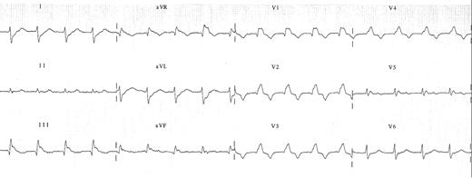 12-lead ECG of broad complex tachycardia.