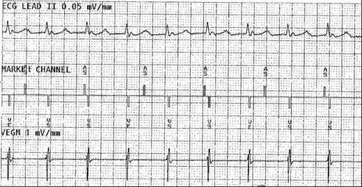 AV dissociation from intracardiac EGM Figure.