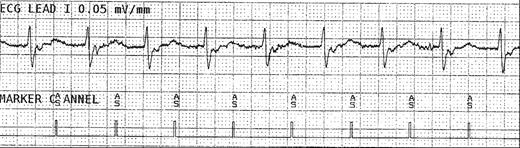 1:1 conduction following lead repositioning.