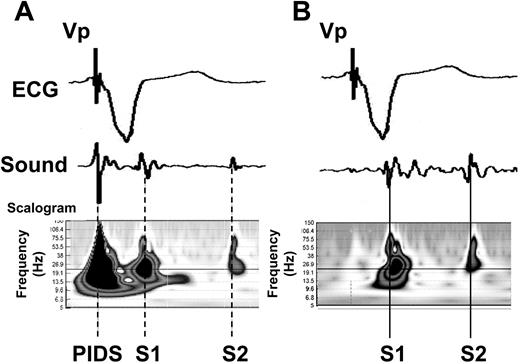 Representative time domain (ECG, heart sound) as well as scalogram illustrations (heart sound only) for cardiac conditions with and without the presence of pacing-induced diaphragmatic stimulation (PIDS) and the corresponding sound artefacts. ( A ) PIDS induced as a side effect of ventricular pacing and ( B ) ventricular pacing without PIDS. ECG, electrocardiogram; S1, first heart sound; S2, second heart sound; PIDS, pacing-induced diaphragmatic stimulation; Vp, ventricular pacing pulse. Scalogram=squared magnitude of the wavelet transform, showing the amount of signal energy as a function of time and frequency.
