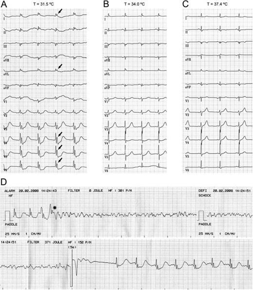 Electrocardiograms of an out-of-hospital cardiac-arrest survivor who experienced multiple episodes of refractory VF during therapeutic hypothermia. The 12-lead ECG obtained at 31.5°C showed QT prolongation and giant Osborn waves in the left lateral leads ( A , arrows), which progressively decreased in amplitude with rewarming ( B , C ). Single-lead recording during VF episodes revealed initiating premature beats with a short coupling related to the preceding prominent J wave ( D , asterisk).