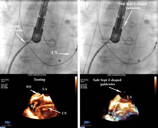 ( A ) ‘Tenting’ effect of fossa ovalis during trans-septal puncture. ( B ) Trans-septal puncture with visualization of Safe Sept J-shaped guidewire in the left atrium, and ‘tenting’ of fossa ovalis around the dilator. FO, fossa ovalis; LA, left atrium; RA, right atrium; CS, coronary sinus.