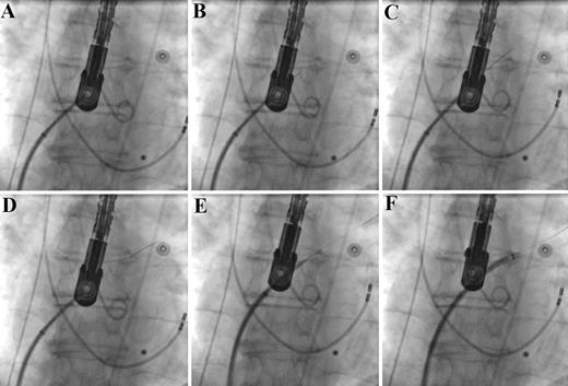 Sequence of antero-posterior X-ray images showing the trans-septal puncture with the Safe Sept J-shaped guidewire: ( A ) trans-septal system positioned against the inter-atrial septum; ( B ) crossing of the septum with the Safe Sept J-shaped guidewire; ( C ) advancement of the guidewire towards the left superior pulmonary vein; ( D ) guidewire placed in the left superior pulmonary vein; ( E ) advancement of the trans-septal system in the left atrium ‘over the wire’; ( F ) retraction of needle and dilator: leaving the sheath in the left atrium under saline flush.