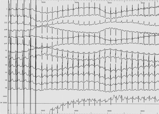 AV nodal re-entrant tachycardia.