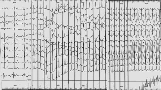 Child with a normal ECG; appearance of a typical Wolff–Parkinson–White syndrome during atrial pacing; induction of AV re-entrant tachycardia.