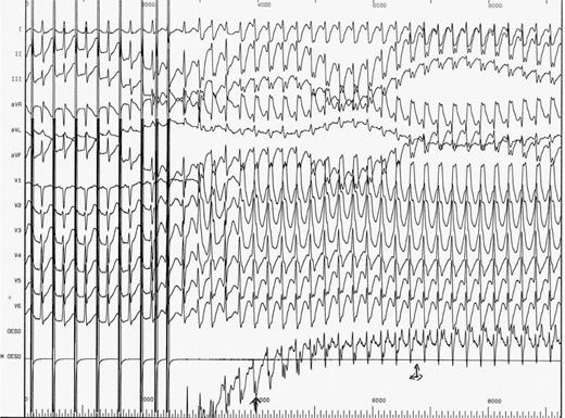 Induction of a wide QRS tachycardia with a right bundle branch block and left atrial deviation morphology; AV dissociation (progressive prolongation of VA interval) in favour of a verapamil-sensitive ventricular tachycardia.