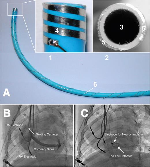 ( A ) Sheath for delivery of a permanent neurostimulation lead. The small pictures are enlargements of the tip of the sheath with the incorporated electrodes (1: lateral view; 2: frontal view). The sheath has a lumen (3) which can be used for angiographic imaging of the coronary sinus and lead advancement. The incorporated electrodes allow probatory electrical stimulation to exclude ventricular capture and identify areas with negative dromotropy during high-frequency stimulation without repetitive screw-in attempts of the lead. The electrode design offers bipolar electrical stimulation with myocardial contact either in a lateral (4: electrode surface) or in a frontal (5: electrode surface) plane. 6: Wiring at the shaft of the sheath. ( B ) Left-lateral fluoroscopy of the canine heart during acute study. An additional atrial lead was implanted for induction and maintenance of AF and a ventricular lead for recording of ventricular rate. Via the guiding catheter, a coronary sinus angiography is performed to ease identification of the RIGP. Once an effective stimulation site has been identified by probatory stimulation via the bipolar electrodes at the tip of the sheath, the permanent electrode can be advanced through the sheath and immediately fixed at this site without exchange or movement of the sheath. A pigtail catheter is positioned in the left ventricle. ( C ) Screw-in electrode positioned in the RIGP for neurostimulation.