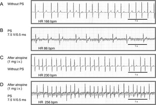 ECG tracings illustrating the negative dromotropic effect of neurostimulation during AF and its dependence on muscarinergic receptor activation. ( A ) Atrial fibrillation with rapid ventricular rate but without PS. ( B ) Neurostimulation with a stimulation voltage of 7.5 V, impulse duration of 0.5 ms, and stimulation frequency of 20 Hz results in a significant reduction of the average ventricular rate from 166 to 86 bpm. ( C ) Administration of 1 mg atropine iv increases heart rate to 230 bpm without neurostimulation. ( D ) After injection of atropine, the neurostimulation effect is no longer reproducible. Paper speed 25 mm/s.