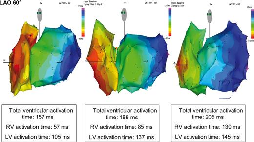 Colour-coded electroanatomical 10 ms isochronal maps (in LAO 60° projection), acquired with contact mapping system, of right ventricle and left ventricular (LV) activation in three patients with left bundle branch block and heart failure. Total ventricular activation time, and both right ventricular (RV) and LV activation times in each patients are reported. With the prolongation of the total duration time, the RV activation time increased proportionally more than the LV activation time.