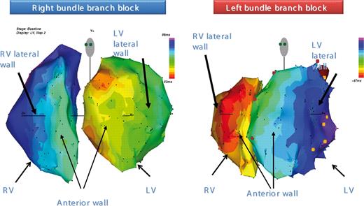 Detailed high resolution colour-coded electroanatomical isochronal maps, acquired with contact mapping system, that show RV and LV activations in two heart failure patients. Activation of the two ventricles is shown, on the left, for a patient with right bundle branch block and, on the right, for a patients with left bundle-branch block.