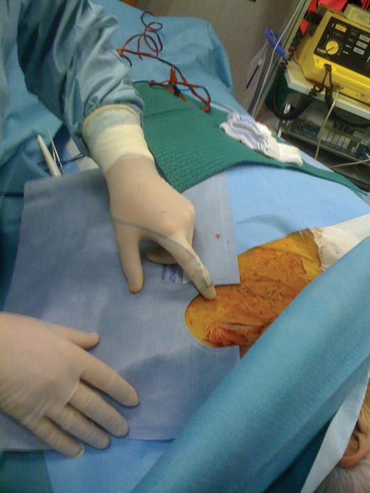 Positioning of the RADPAD during pectoral device implants. The shield is placed slightly lateral to the incision site and outside the beam path. Also shown in this figure is the positioning of the active dosimeter at operator's finger.